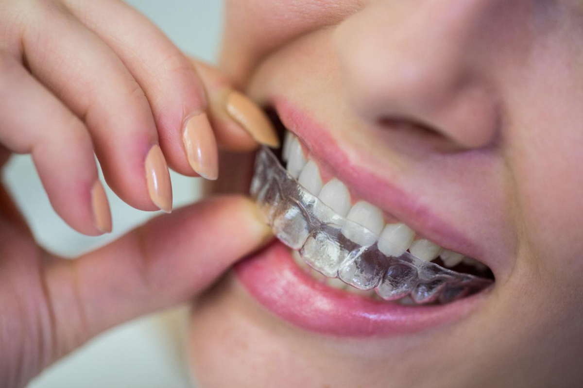 Kā izvēlēties saudzīgas zobu balināšanas plāksnītes?